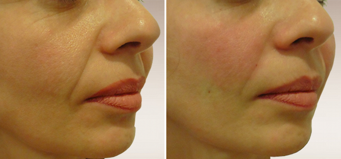 filler acido ialuronico juvederm