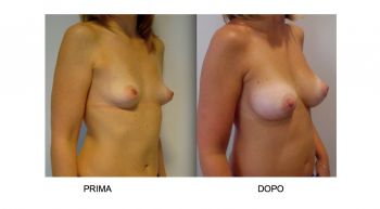 Mastoplastica additiva protesi mammarie anatomiche
