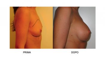 Mastoplastica additiva per l'aumento del seno