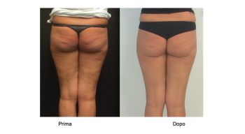 Mesoterapia